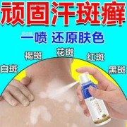 孕妇身上长了花斑癣怎么办,孕期长汗斑可以用药吗
