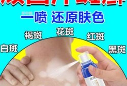 孕妇身上长了花斑癣怎么办,孕期长汗斑可以用药吗
