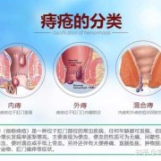 孕期痔疮能自愈吗（内外混合痔能自愈吗）