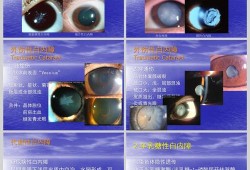 宝宝白内障能治愈吗,胎儿白内障能检查出来吗