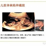 胎儿肢体短（胎儿肢体短小畸形的诊断标准）