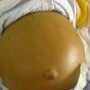 胎儿胆道闭锁（胎儿胆道闭锁）