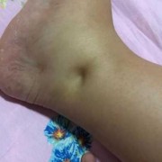孕期没有水肿正常吗（已经怀孕六个多月了，还没有水肿，但是还会水肿吗？有什么特点）