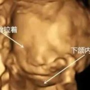 胎儿小下颌畸形图片（下颌后缩是怎么回事）