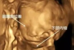 胎儿小下颌畸形图片（下颌后缩是怎么回事）
