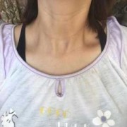 胎儿颈部褶皱（胎儿颈部褶皱厚度多少正常）