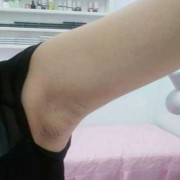 孕妇腋下淋巴结肿大怎么办,孕期腋窝淋巴结肿大怎么回事