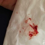怀孕了流鼻血是怎么回事,怀孕期间出血是什么原因导致的