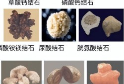 孕妇肾结石伴又肾积水如何治疗?孕中期时候，对胎儿有什么危害,孕妇三个动作排出肾结石