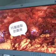 卵巢囊肿破裂怎么回事呢,孕期囊肿破裂什么症状