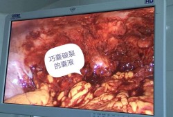 卵巢囊肿破裂怎么回事呢,孕期囊肿破裂什么症状