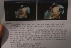 孕27周4天，左侧侧脑室宽约0.7CM，正常吗,胎儿脑室正常值是多少