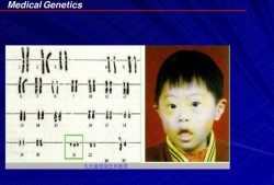 胎儿染色体畸形（胎儿染色体畸形是什么原因）