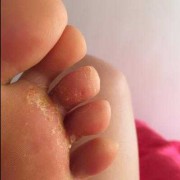孕期脚趾痒（孕期脚趾痒）