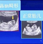 胎儿小头畸形的诊断标准是怎样的？怀孕8个月多，要注意什么呢,胎儿头颅核磁检查什么