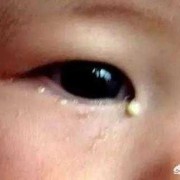 6个月胎儿图片（宝宝6个月了，眼睛还是有很多眼屎，怎么回事）