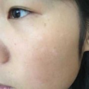 孕期脸上长白斑正常吗（孕期脸上长白斑正常吗图片）