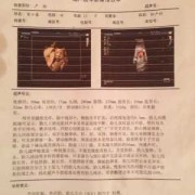 胎儿后颅窝池正常值（胎儿后颅窝池正常值）