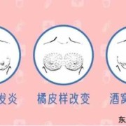 如何缓解孕期乳腺增生（哺乳期的乳腺增生，该怎么办）