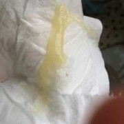 孕期白带黄稠（白带发黄粘稠是怎么回事）