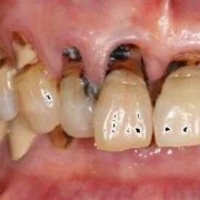 孕期牙断裂（牙齿断裂的原因）