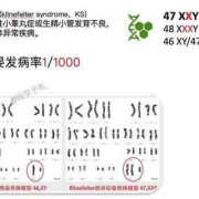 胎儿XXY（胎儿XXY染色体原因）