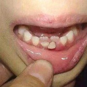 宝宝下面2颗牙出来后，要多久才长上面的牙齿呢,胎儿到婴儿的过程叫什么