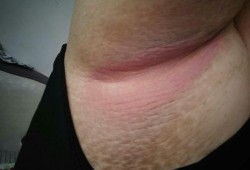 怀孕后腋窝有异味怎么办,孕期腋窝疼是怎么回事
