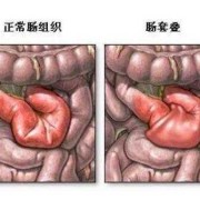 胎儿肠阻（胎儿肠阻梗用引产吗）