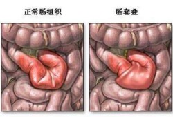 胎儿肠阻（胎儿肠阻梗用引产吗）