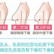 怀孕乳房下垂怎么纠正？方法是什么啊,孕期胸下垂正常吗