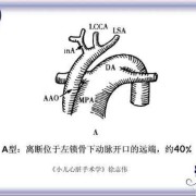 胎儿主动脉弓离断（胎儿主动脉弓离断）