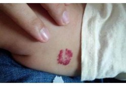 胎儿身上为啥有胎记（婴儿脸上有胎记是怎么回事）