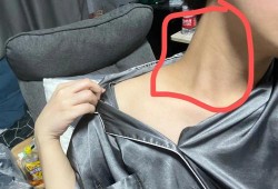 孕期脖子疼（孕期脖子变黑怎么办）