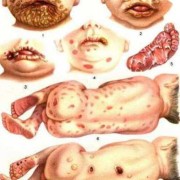 梅毒孕妇生下的孩子会怎样,孕期角膜炎对胎儿有影响吗