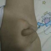 胎儿在鼓包（胎儿在鼓包是什么部位）