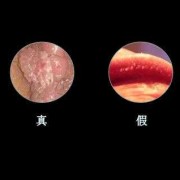 怀孕期间得了尖锐湿疣，怎么办,怀孕期间得了尖锐湿还能不能顺产