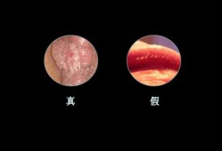 怀孕期间得了尖锐湿疣，怎么办,怀孕期间得了尖锐湿还能不能顺产