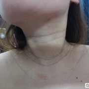 孕期颈纹（孕期颈纹很深产后会消失吗）