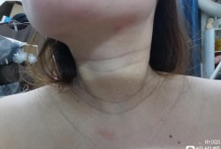 孕期颈纹（孕期颈纹很深产后会消失吗）