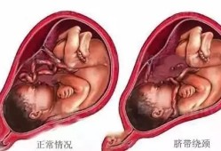 胎儿入盆后还会有胎动吗（胎儿入盆了还会脐带绕颈吗）