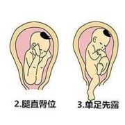 胎儿如果是臀位怎么办,孕妇臀位对胎儿有影响吗