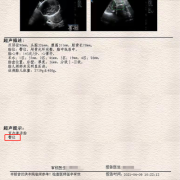 足月胎儿b超（足月胎儿b超数据）
