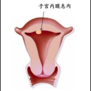 孕期息肉怎样预防感染（子宫内膜息肉怎么预防复发）