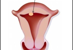 孕期息肉怎样预防感染（子宫内膜息肉怎么预防复发）