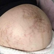 孕期无妊娠纹（怎么才能没有妊娠纹）