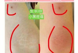 妊娠纹是什么意思,怀孕期间妊娠纹怎么可以彻底消除