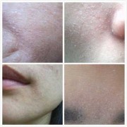 孕期皮肤干燥起皮怎么办（怀孕晚期的孕妇，脸上脱皮该怎么办呢）