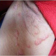 孕期腋下湿疹怎么办（孕期腋下湿疹怎么办）