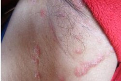 孕期腋下湿疹怎么办（孕期腋下湿疹怎么办）